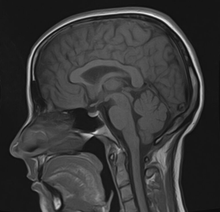 МРТ головного мозга