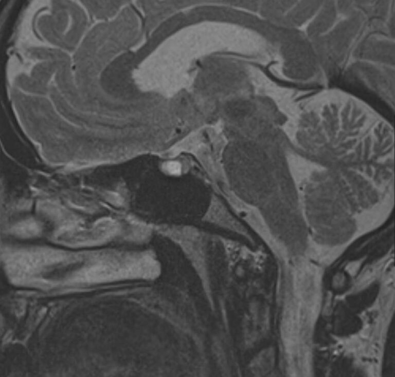 МРТ головного мозга и гипофиза