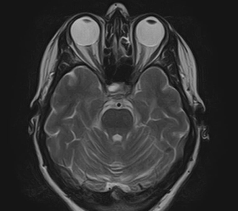 МРТ головного мозга и гипофиза