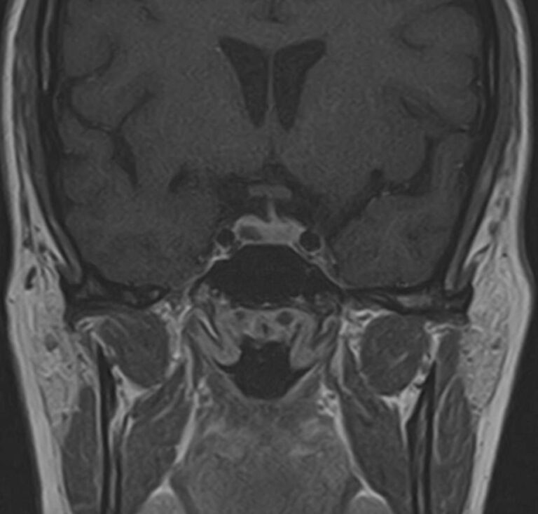 МРТ головного мозга и гипофиза