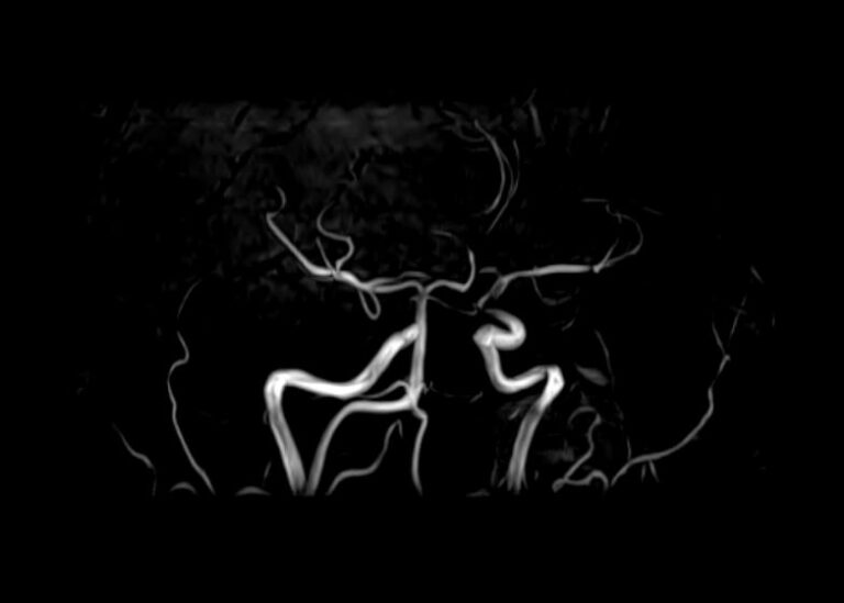 МР-ангиография головного мозга