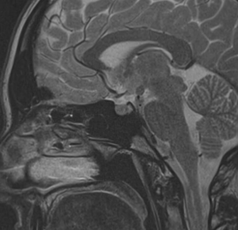 МРТ гипофиза