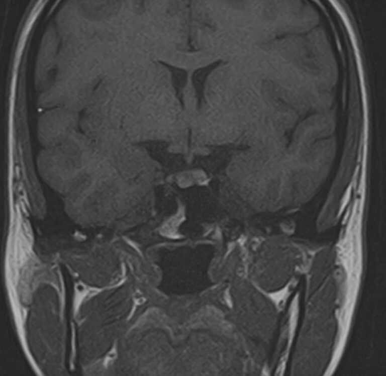 МРТ гипофиза