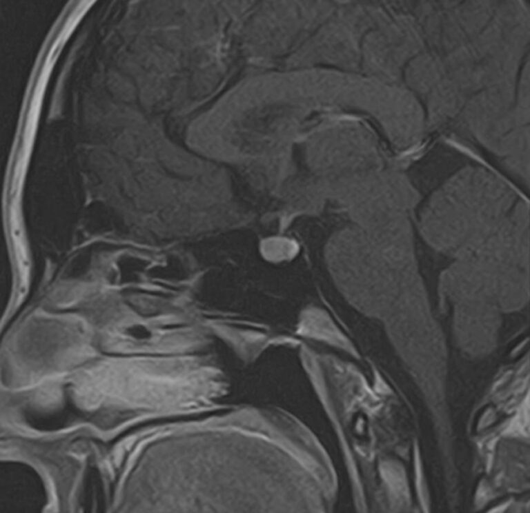 МРТ гипофиза