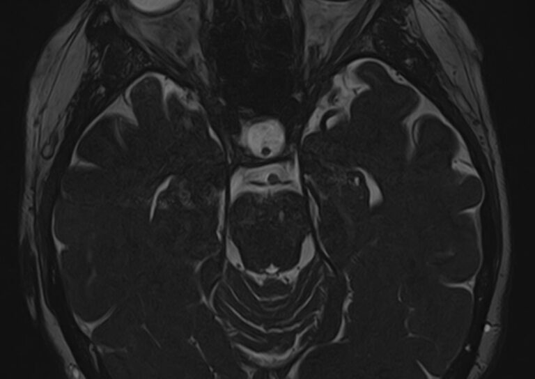 МРТ черепно-мозговых нервов