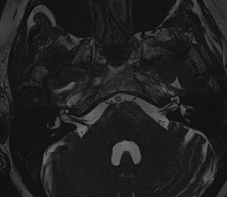 МРТ черепно-мозговых нервов