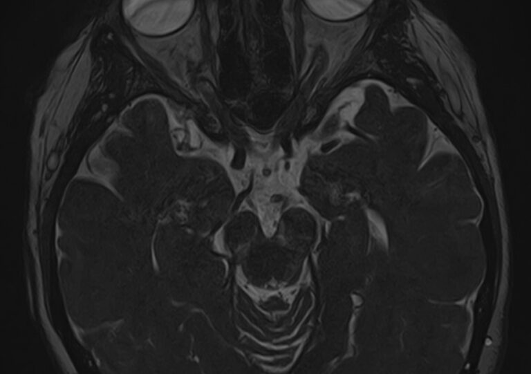 МРТ черепно-мозговых нервов