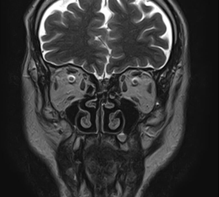 МРТ придаточных пазух носа