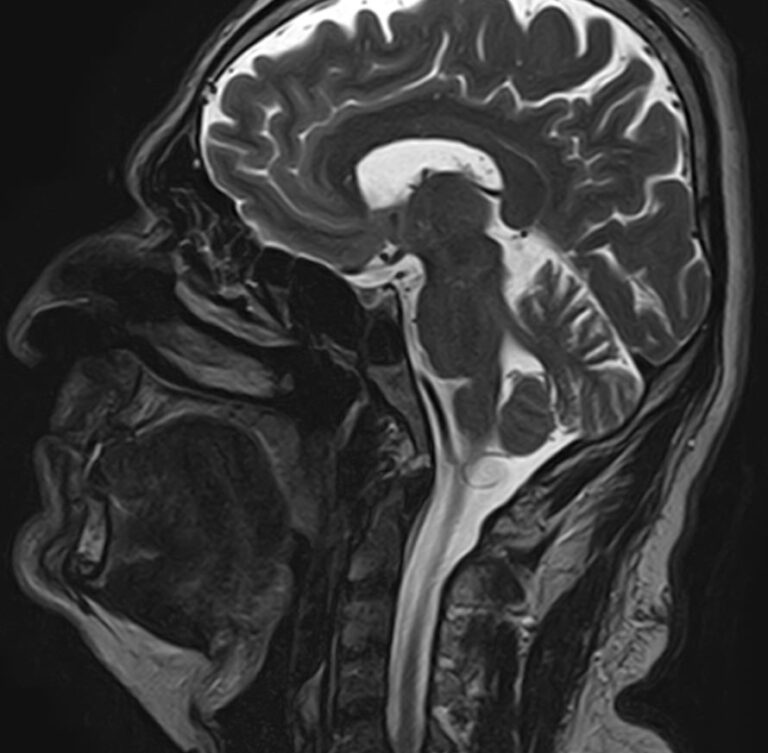 МРТ придаточных пазух носа