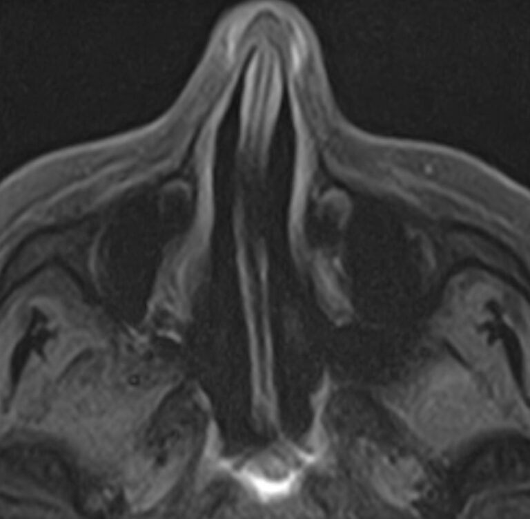 МРТ придаточных пазух носа