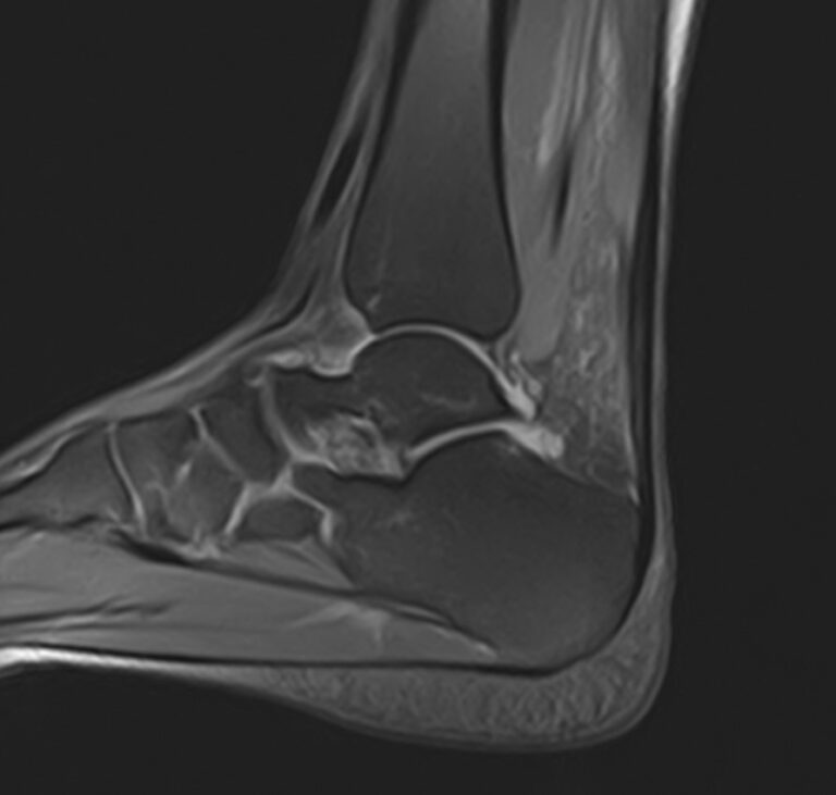 МРТ голеностопного сустава