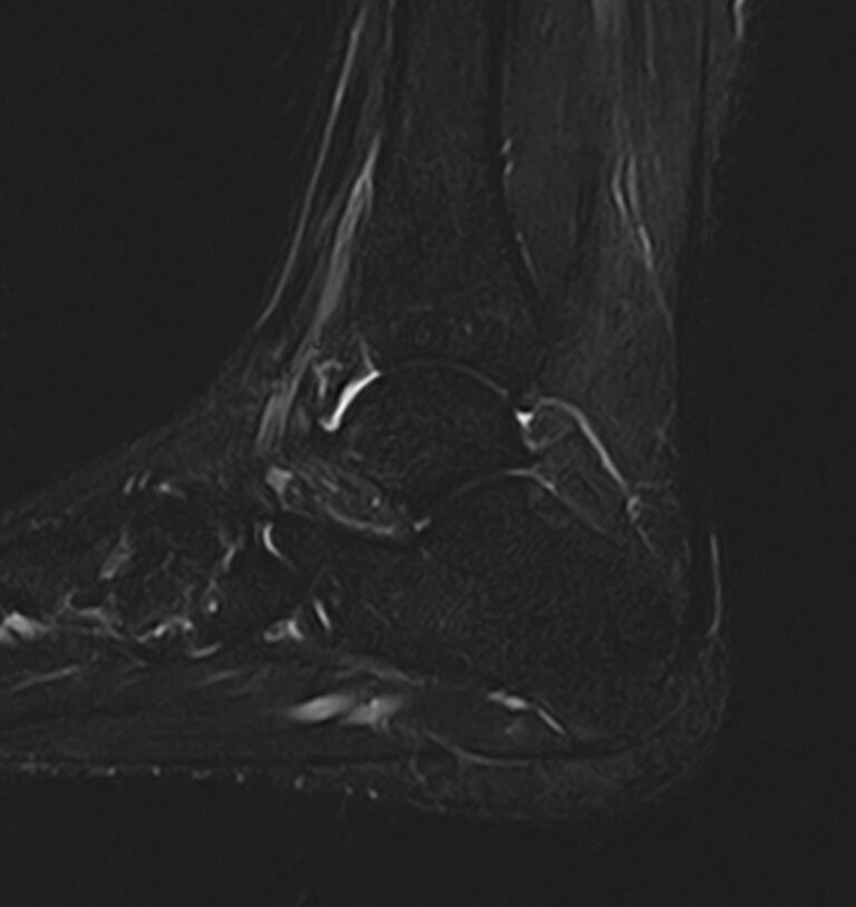 МРТ голеностопного сустава