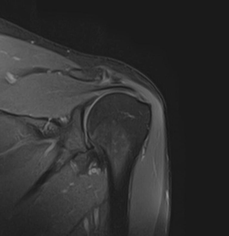 МРТ плечевого сустава