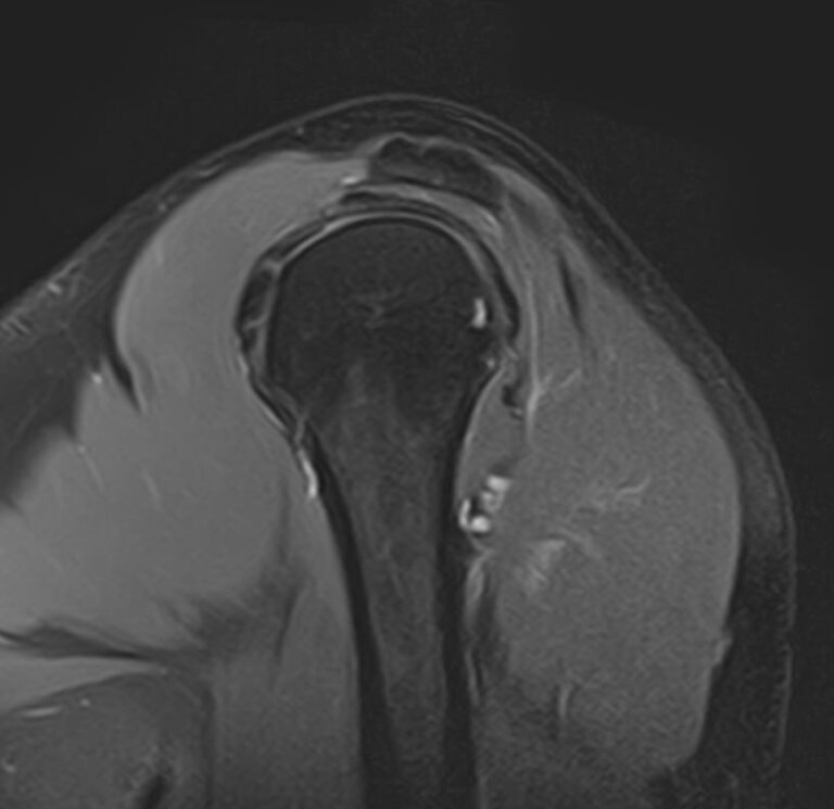 МРТ плечевого сустава