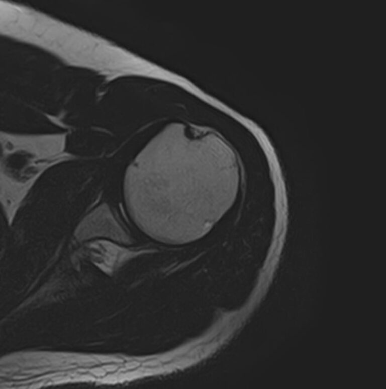 МРТ плечевого сустава