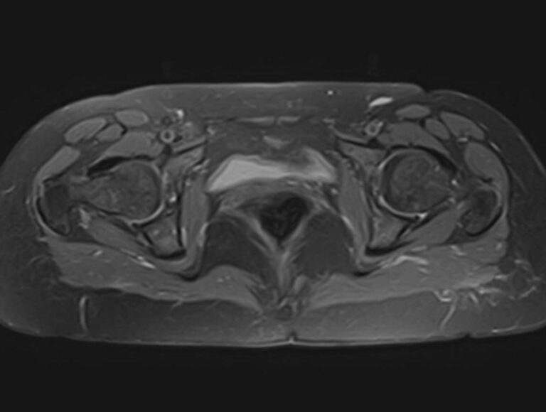 МРТ тазобедренных суставов