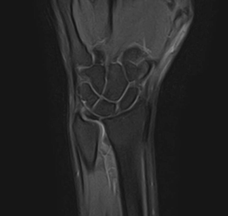 МРТ лучезапястного сустава
