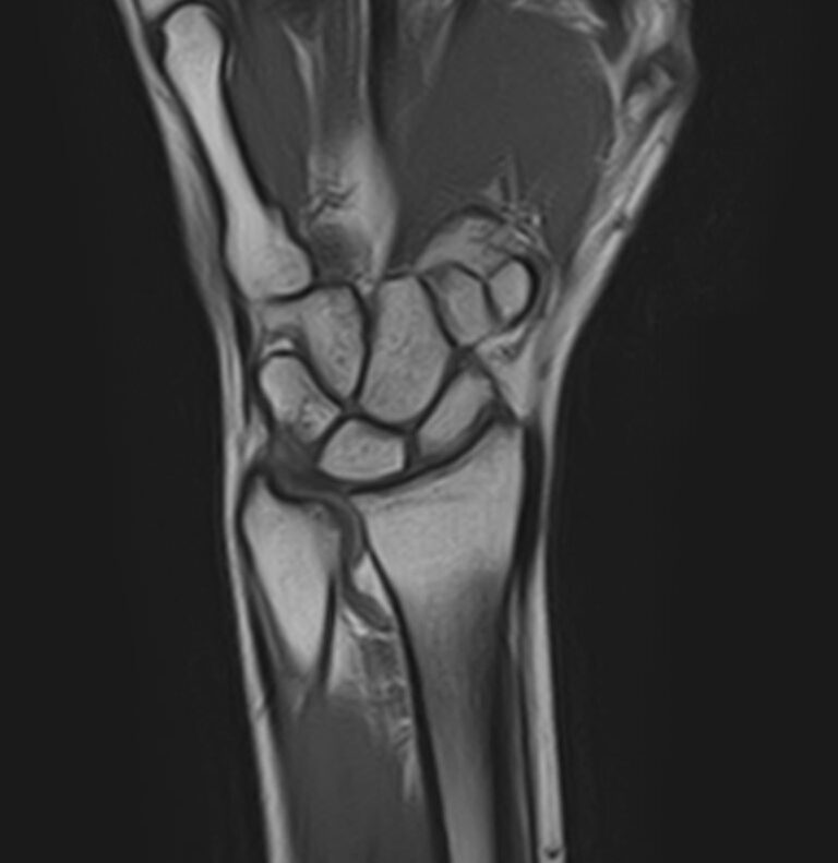 МРТ лучезапястного сустава