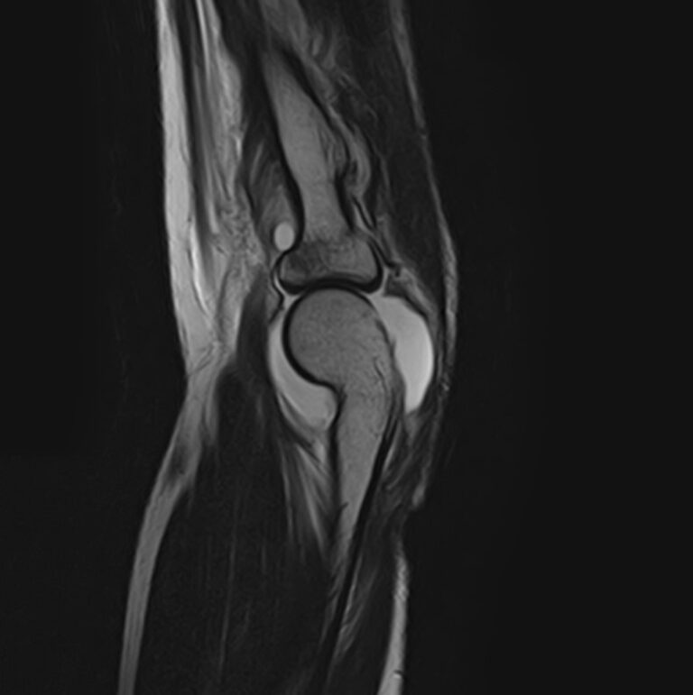 МРТ локтевого сустава