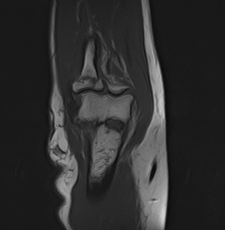 МРТ локтевого сустава