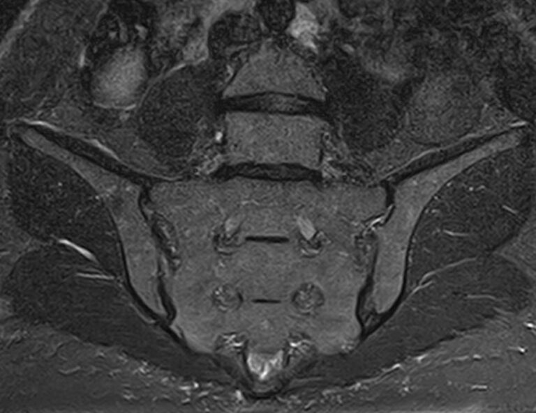 МРТ крестцово-подвздошных суставов