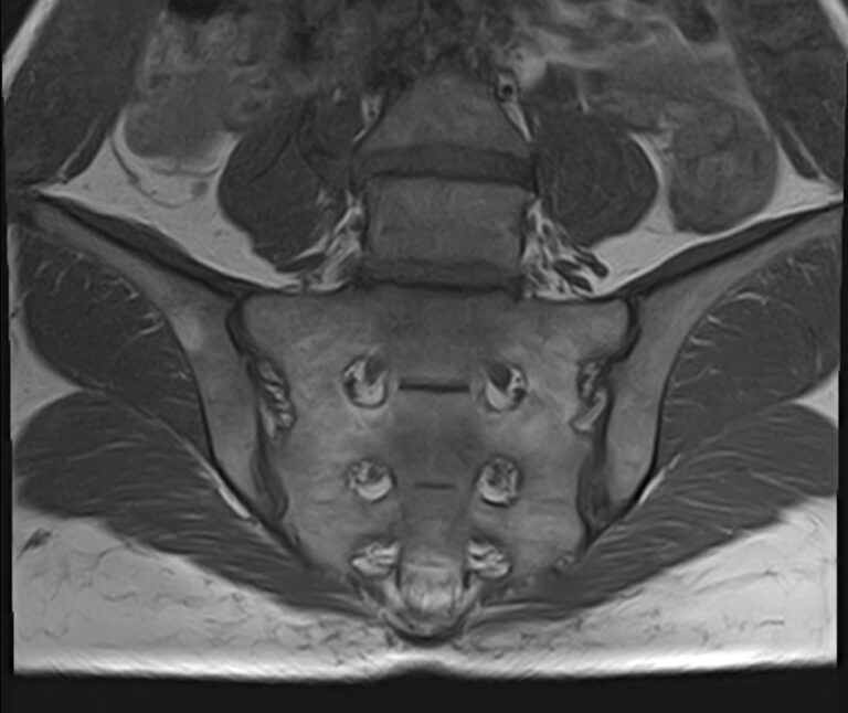 МРТ крестцово-подвздошных суставов