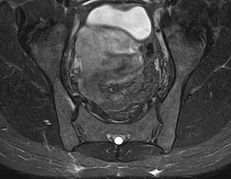 МРТ крестцово-подвздошных суставов