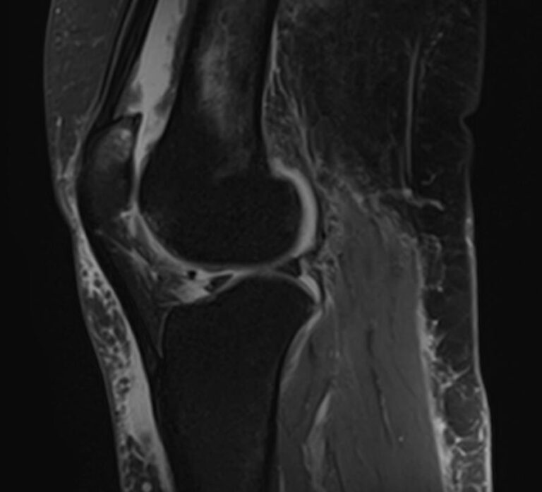 МРТ коленного сустава