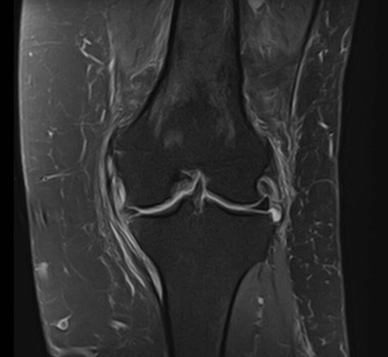 МРТ коленного сустава