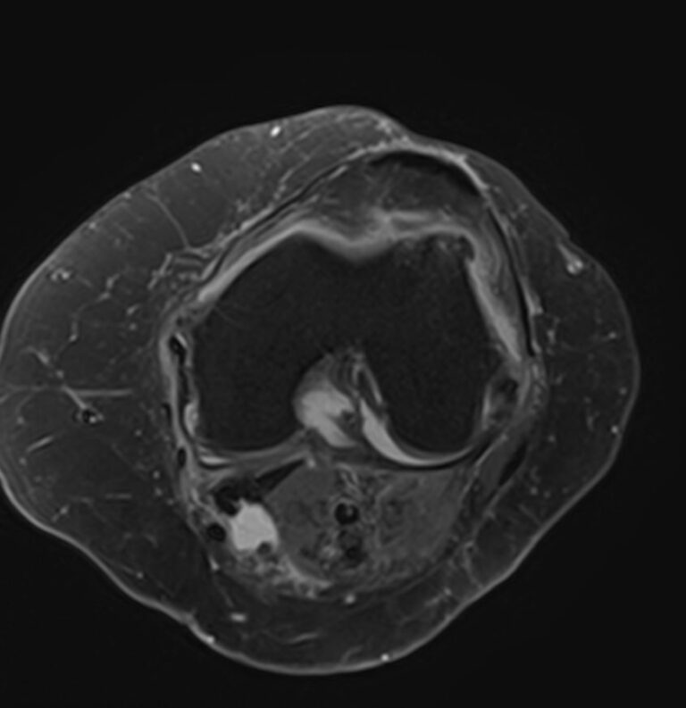 МРТ коленного сустава