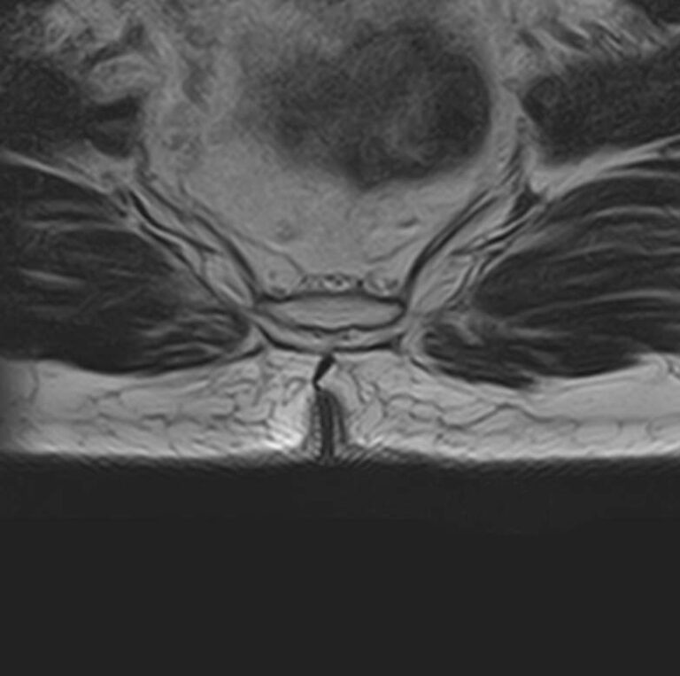 МРТ копчика