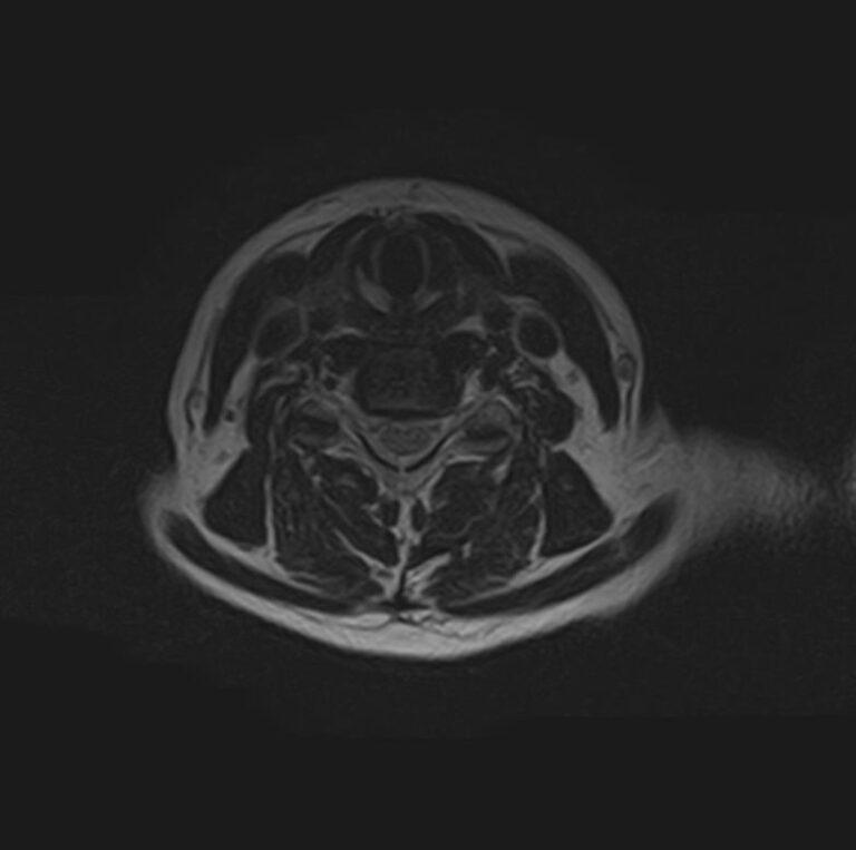 МРТ шейного отдела и головного мозга