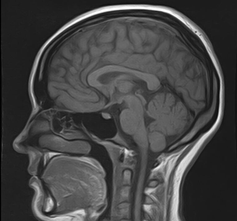 МРТ центральной нервной системы (ЦНС)