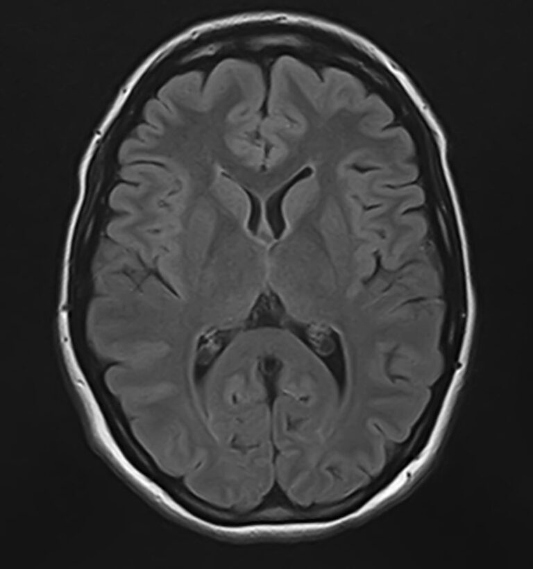 МРТ центральной нервной системы (ЦНС)