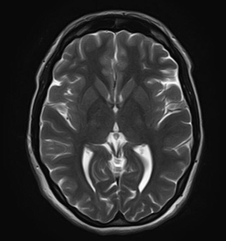 МРТ центральной нервной системы (ЦНС)