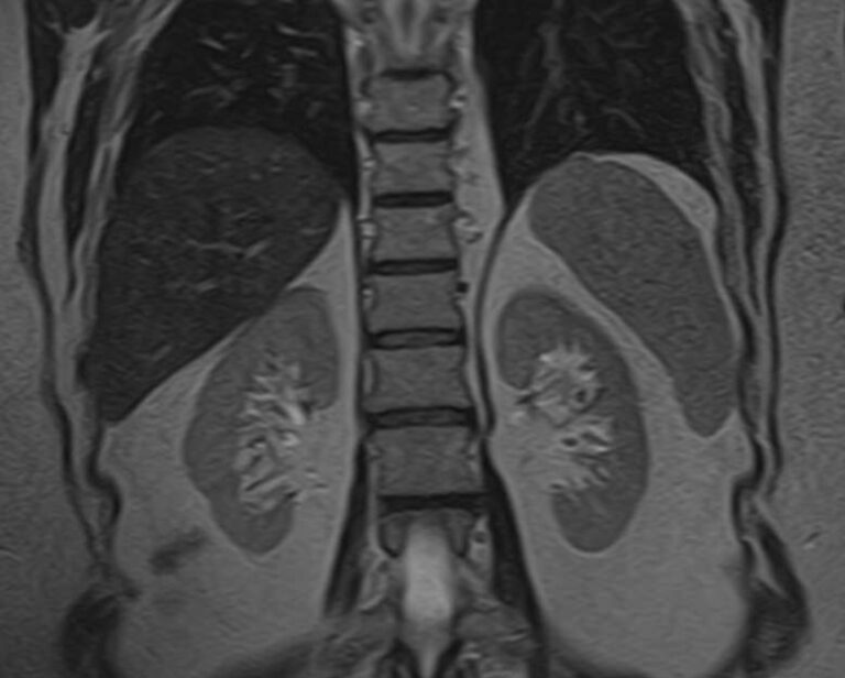МРТ надпочечников