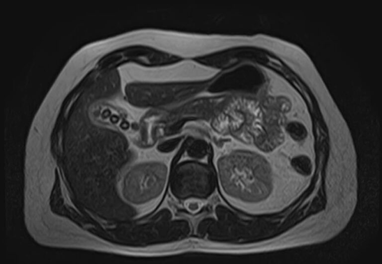 МРТ надпочечников