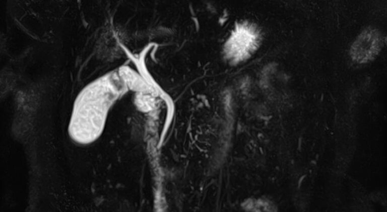 МРТ поджелудочной железы