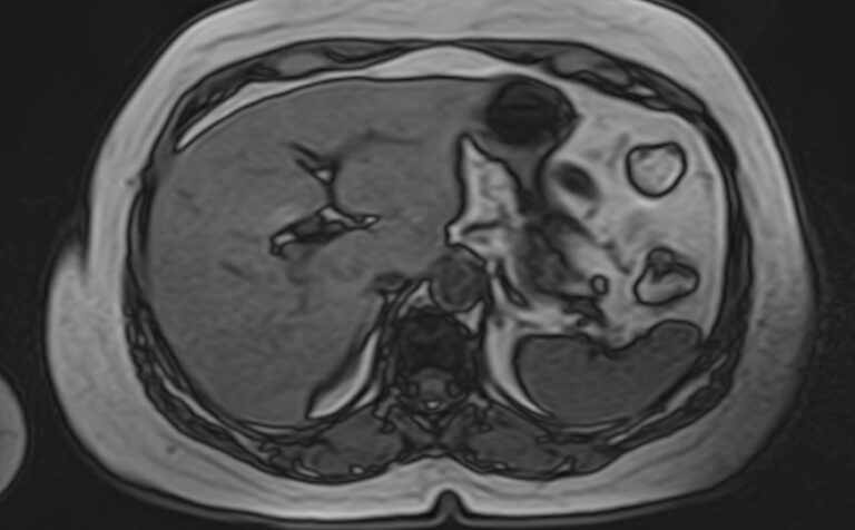 МРТ селезёнки