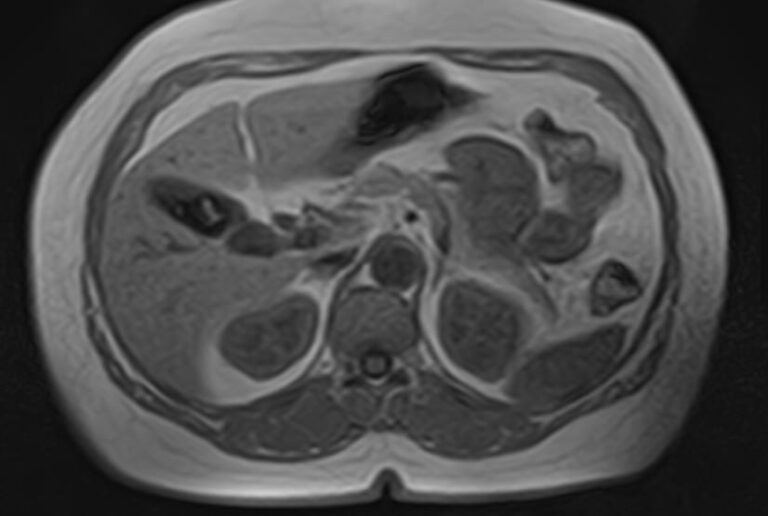 МРТ забрюшинного пространства