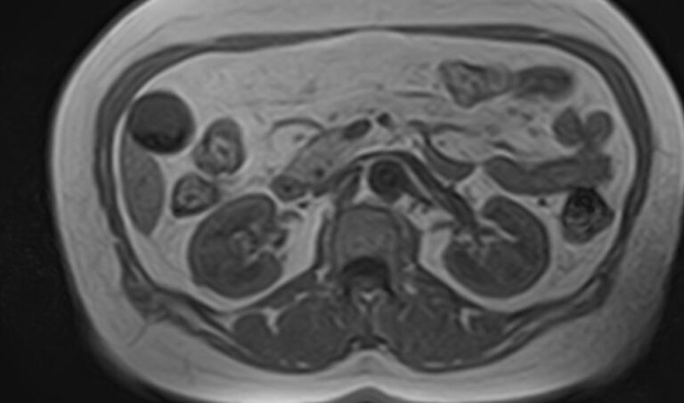 МРТ мочеточников