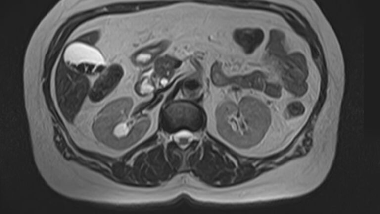 МРТ мочеточников