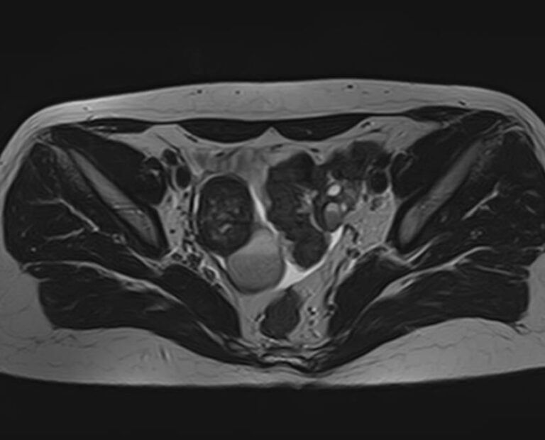 МРТ яичников