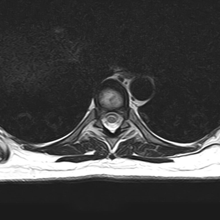 МРТ грудного отдела позвоночника, режим Т2, аксиальная плоскость