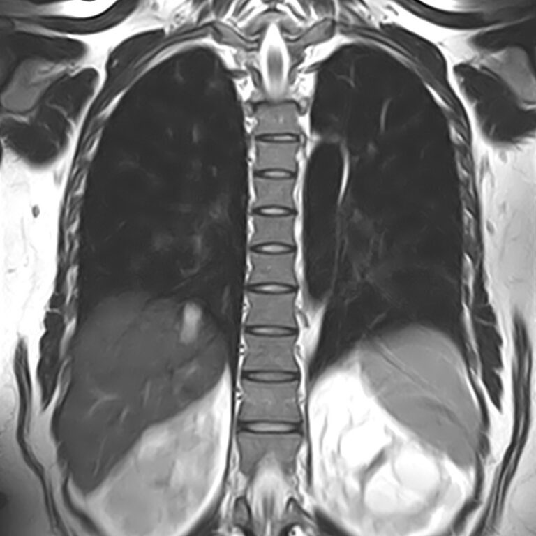 МРТ грудного отдела позвоночника, режим Т2, корональная плоскость