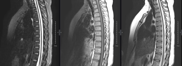 МРТ грудного отдела позвоночника, сагиттальная плоскость, режимы слева направо - STIR, Т1, Т2