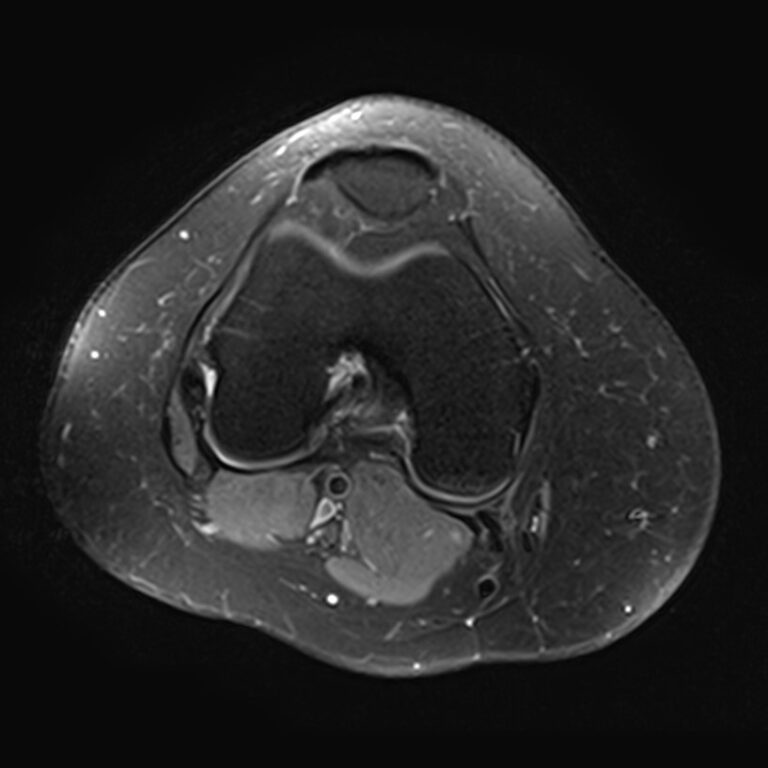 МРТ коленного сустава, режим Pd FS, аксиальная плоскость
