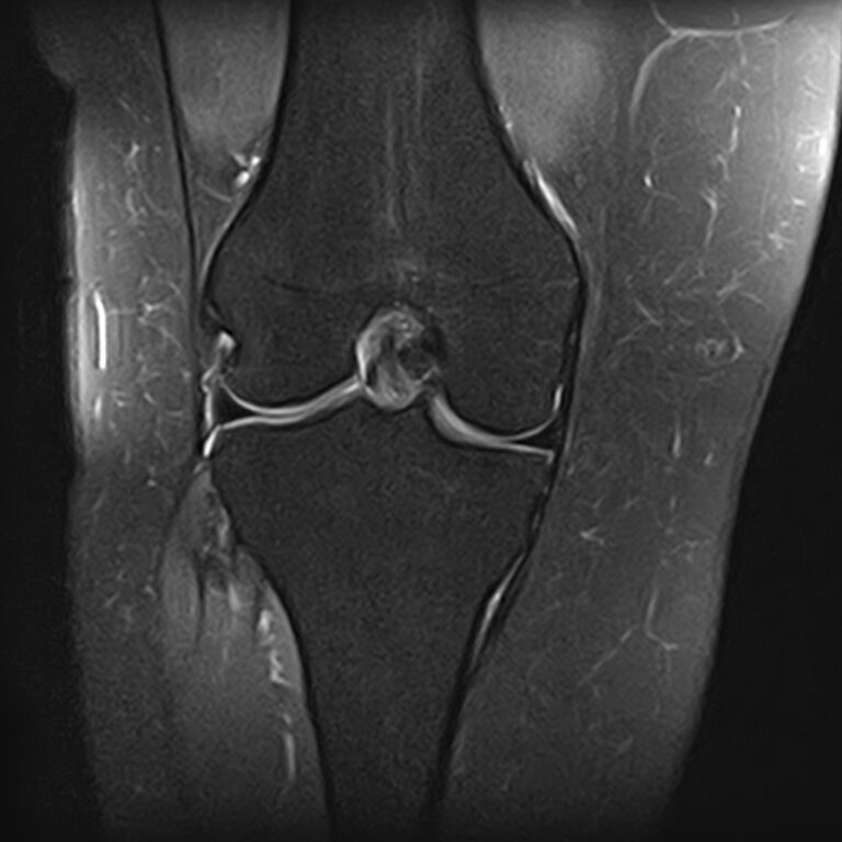 МРТ коленного сустава, режим Pd FS, корональная плоскость