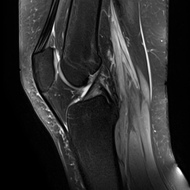 МРТ коленного сустава, режим Pd FS, сагиттальная плоскость
