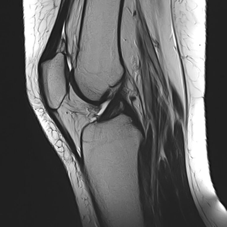 МРТ коленного сустава, режим Т2, сагиттальная плоскость